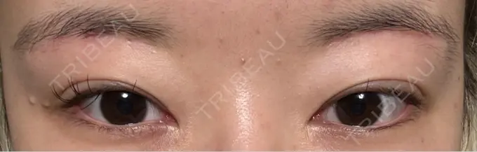 下まぶたの脂肪取り / 眉下切開 東京中央クリニック AFTER メイン用