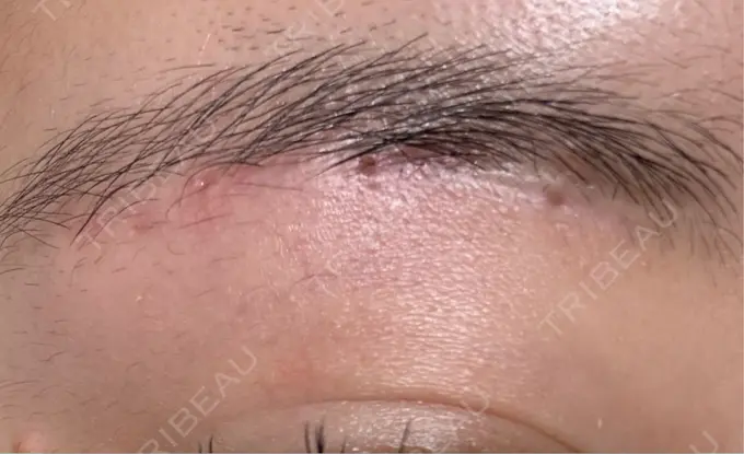 下まぶたの脂肪取り / 眉下切開 東京中央クリニック DAY 115 メイン用