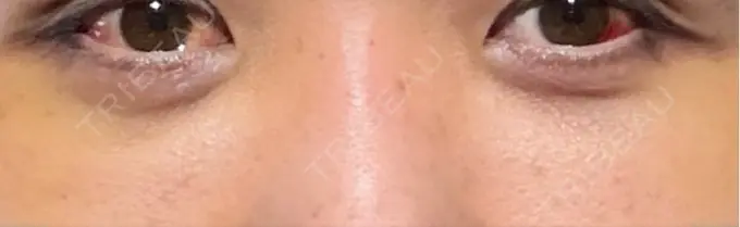 クマ治療 藤・ナチュレ美容クリニック 銀座院 DAY 7 メイン用