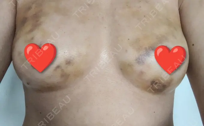 豊胸（脂肪注入） 湘南美容クリニック Regno 銀座院 DAY 3 メイン用