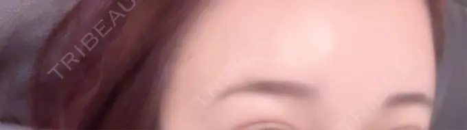 ヒアルロン酸注入（額） / ボトックス（眉間） / ボトックス（額） DMTC美容皮膚科 大宮院 AFTER メイン用