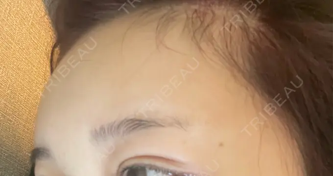 ヒアルロン酸注入（額） / ボトックス（眉間） / ボトックス（額） DMTC美容皮膚科 大宮院 DAY 3 メイン用