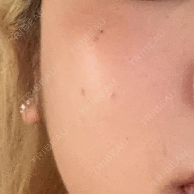 ルメッカ ルラ美容クリニック 名古屋栄院 / ルラスキンクリニック 名古屋栄院 AFTER メイン用