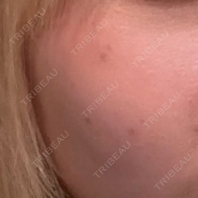 ルメッカ ルラ美容クリニック 名古屋栄院 / ルラスキンクリニック 名古屋栄院 DAY 3 メイン用