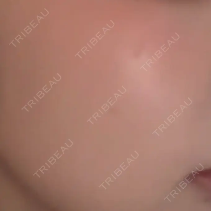 ルメッカ ルラ美容クリニック 名古屋栄院 / ルラスキンクリニック 名古屋栄院 DAY 3 メイン用