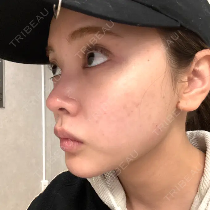 ボトックス（エラ・小顔） / ボトックス（肩） BiBiクリニック AFTER メイン用