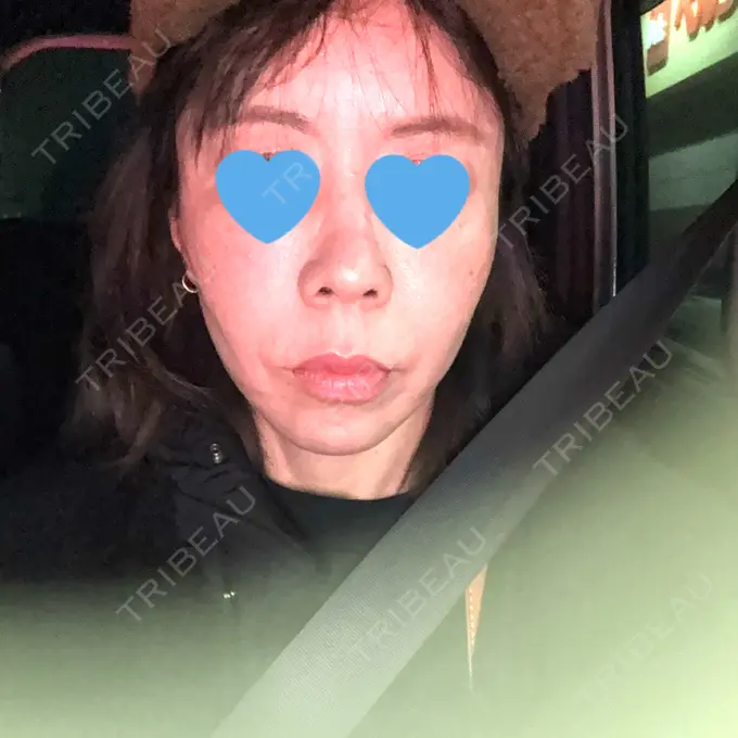 ボトックス（あご） / ボトックス（エラ・小顔） / ボトックス（口角） / ボトックス（肩） / ボトックス（眉間） / ボトックス（目尻） / ボトックス（額） / ボトックス（人中） おおたかの森ビューティークリニック AFTER メイン用