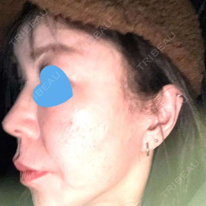 ボトックス（あご） / ボトックス（エラ・小顔） / ボトックス（口角） / ボトックス（肩） / ボトックス（眉間） / ボトックス（目尻） / ボトックス（額） / ボトックス（人中） おおたかの森ビューティークリニック DAY 1 メイン用