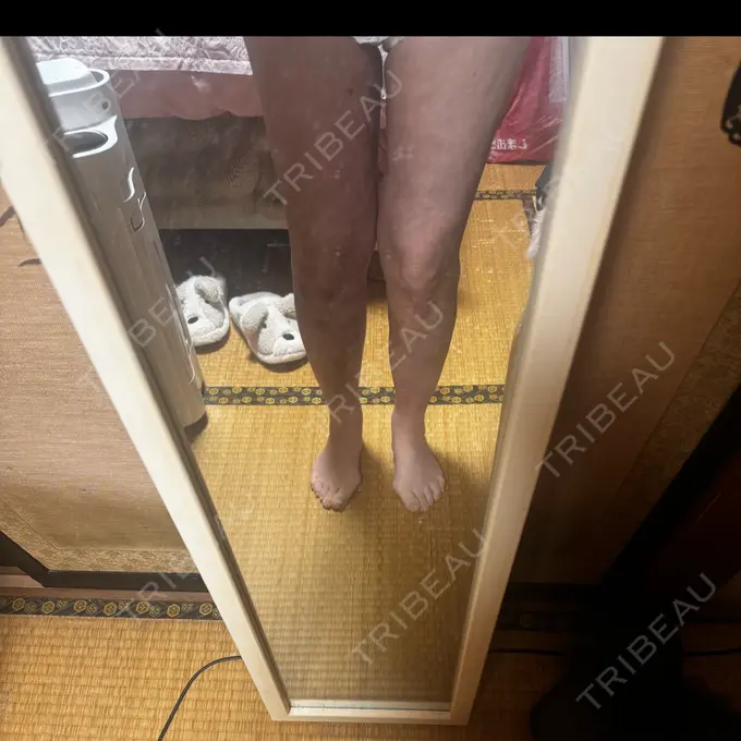 脂肪溶解注射（太もも） HAAB×DREAM BEAUTY CLINIC 東京本院 DAY 71 メイン用