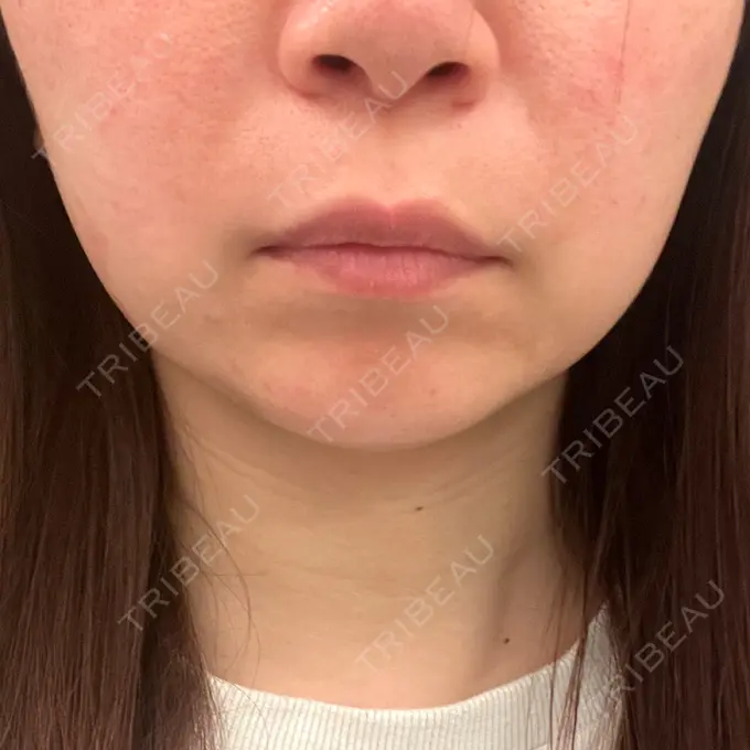 RF（高周波）たるみ治療 ゆきスキンクリニック 東池袋 DAY 5 メイン用