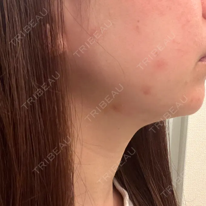 RF（高周波）たるみ治療 ゆきスキンクリニック 東池袋 DAY 5 メイン用