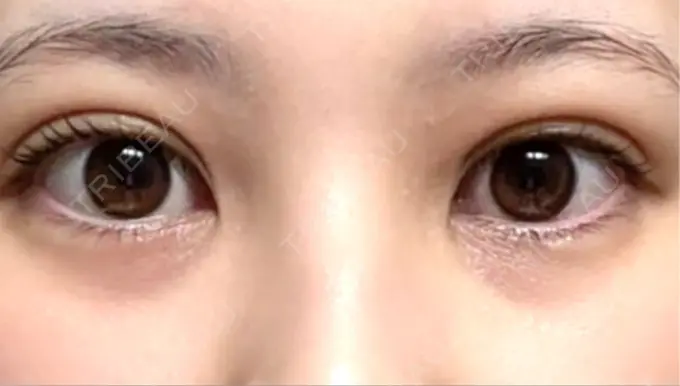 自然癒着法 eクリニック 福岡院 AFTER メイン用