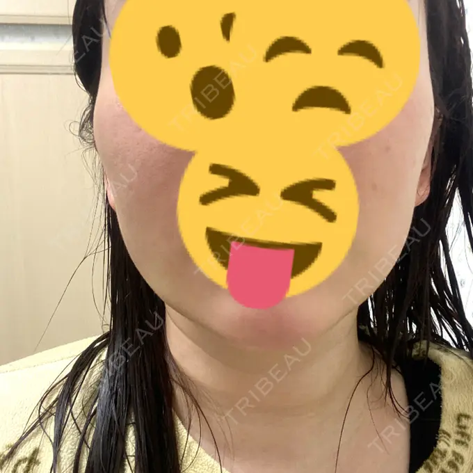 ボトックス（あご） / ヒアルロン酸注入（あご） / ハイフ（顔） / RF（高周波）たるみ治療 ルラ美容クリニック 名古屋栄院 / ルラスキンクリニック 名古屋栄院 AFTER メイン用