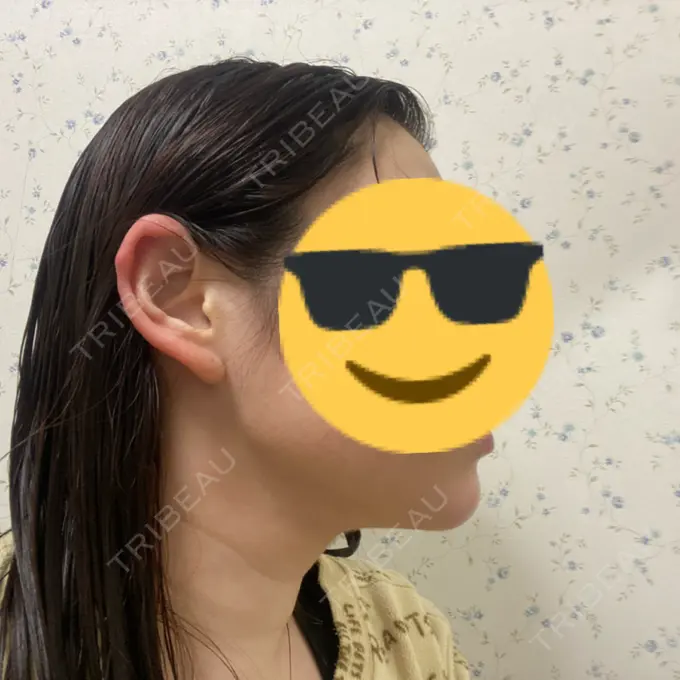 ボトックス（あご） / ヒアルロン酸注入（あご） / ハイフ（顔） / RF（高周波）たるみ治療 ルラ美容クリニック 名古屋栄院 / ルラスキンクリニック 名古屋栄院 DAY 4 メイン用