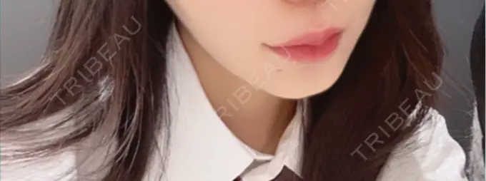 ヒアルロン酸注入（唇） 目白ホワイトクリニック AFTER メイン用