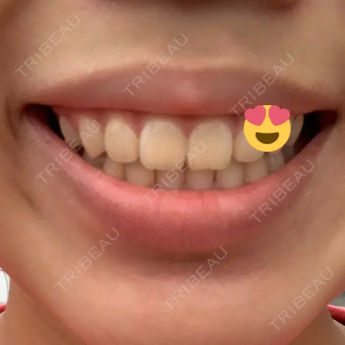 ガミースマイル手術 有楽町美容外科クリニック DAY 1 メイン用