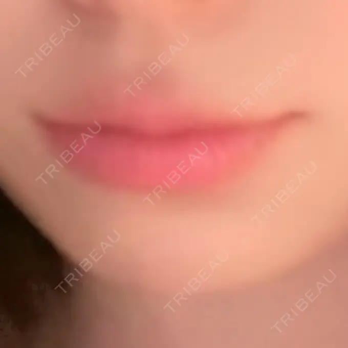 ヒアルロン酸注入（唇） 新未来クリニック DAY 0 メイン用