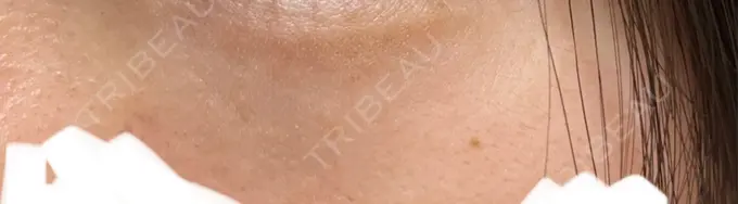 ボトックス（人中） / その他（目元） 東京形成美容外科 船橋院 AFTER メイン用