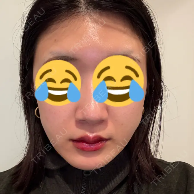 糸リフト / 脂肪吸引（顔） 下北沢スキンクリニック DAY 14 メイン用