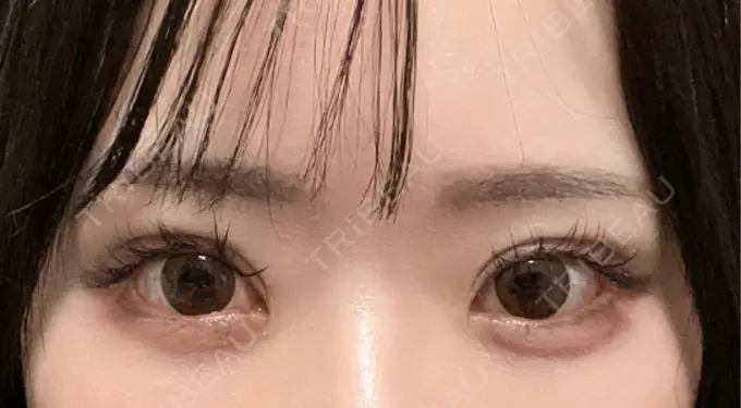 クマ治療 / 下まぶたの脂肪取り / 脂肪注入（目の下） ルラ美容クリニック 渋谷本院 DAY 32 メイン用