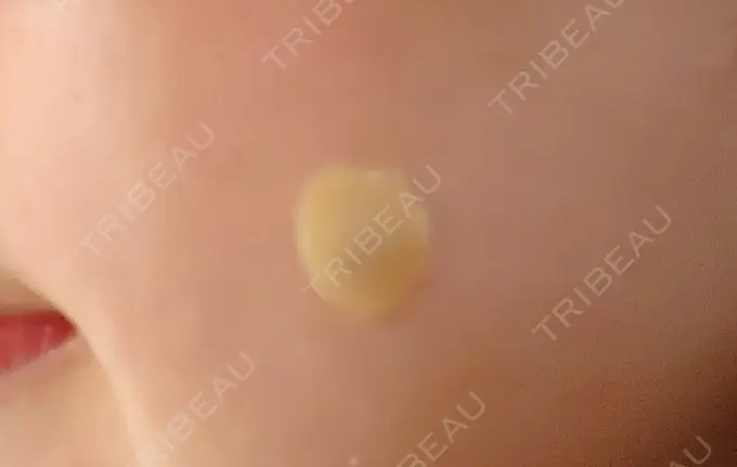 ほくろ・いぼ切除（肌） 札幌中央クリニック DAY 1 メイン用