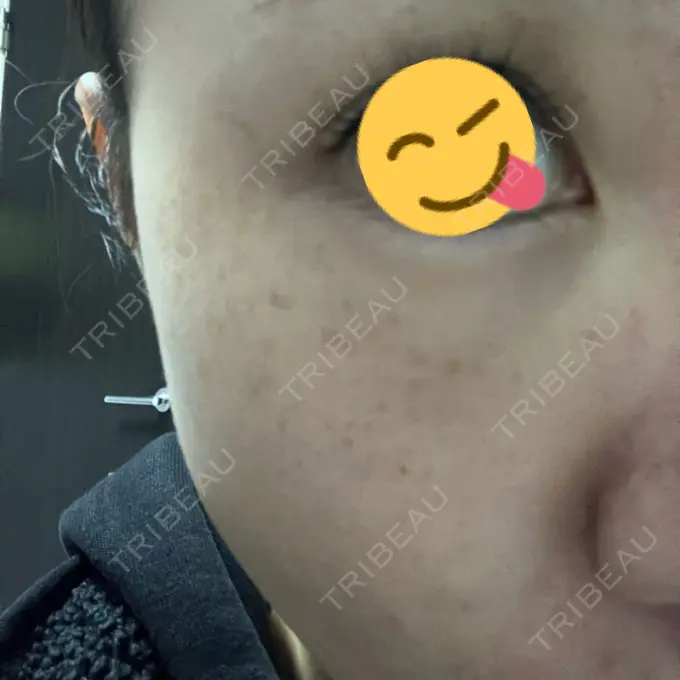 ボトックス（目尻） 東京美容医療クリニック 池袋院 DAY 0 メイン用