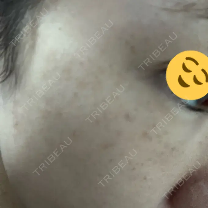 ボトックス（目尻） 東京美容医療クリニック 池袋院 DAY 0 メイン用