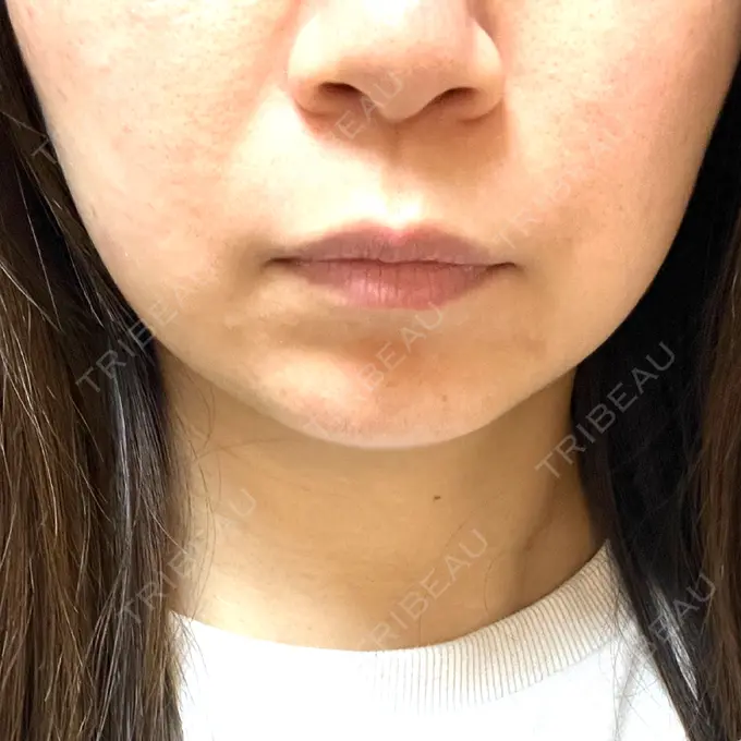 RF（高周波）たるみ治療 ゆきスキンクリニック 東池袋 DAY 6 メイン用