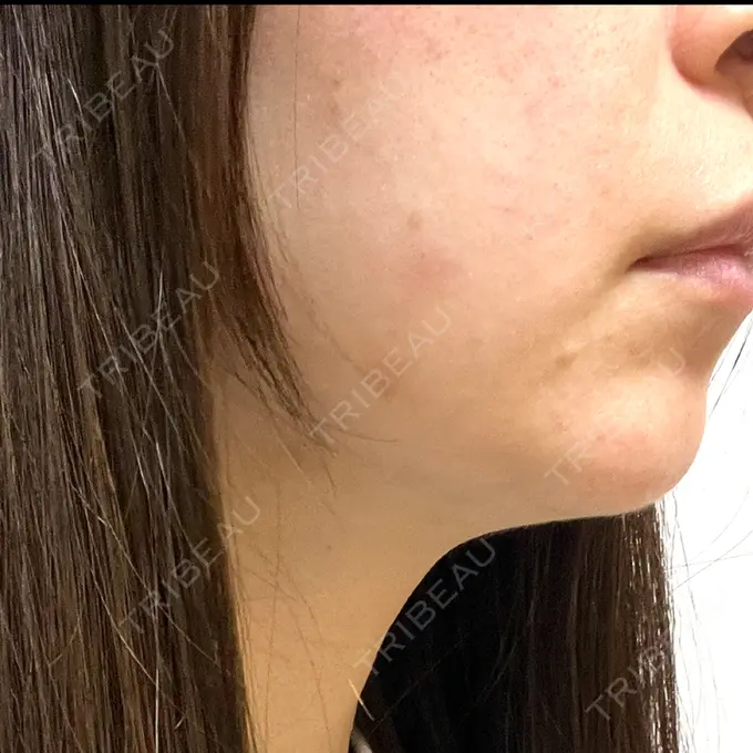 RF（高周波）たるみ治療 ゆきスキンクリニック 東池袋 DAY 6 メイン用