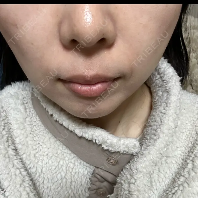 光治療（フォトフェイシャルなど） Sea Sail Beauty Clinic DAY 11 メイン用