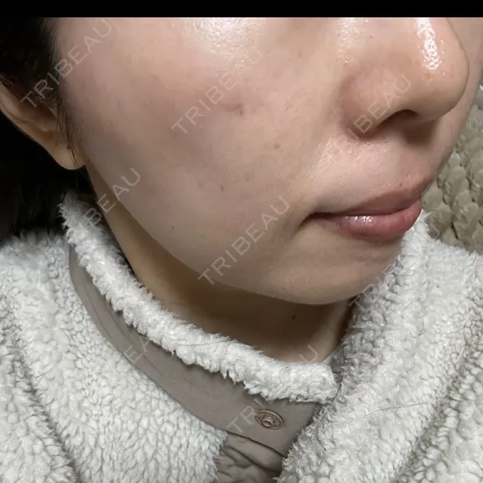 光治療（フォトフェイシャルなど） Sea Sail Beauty Clinic DAY 11 メイン用