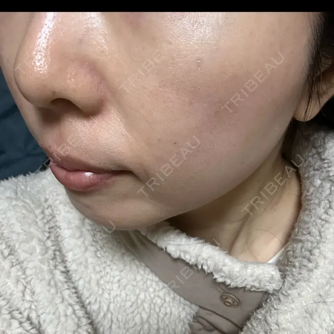 光治療（フォトフェイシャルなど） Sea Sail Beauty Clinic DAY 11 メイン用