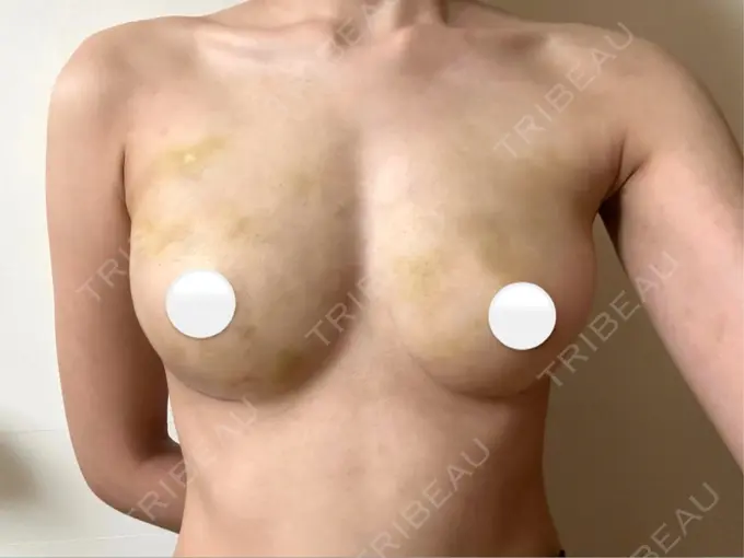 脂肪吸引（脚） / 豊胸（脂肪注入） 湘南美容クリニック Regno 銀座院 DAY 3 メイン用