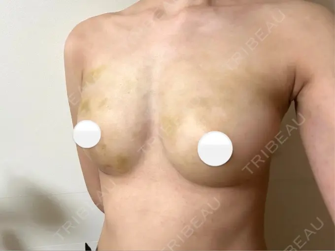 脂肪吸引（脚） / 豊胸（脂肪注入） 湘南美容クリニック Regno 銀座院 DAY 3 メイン用