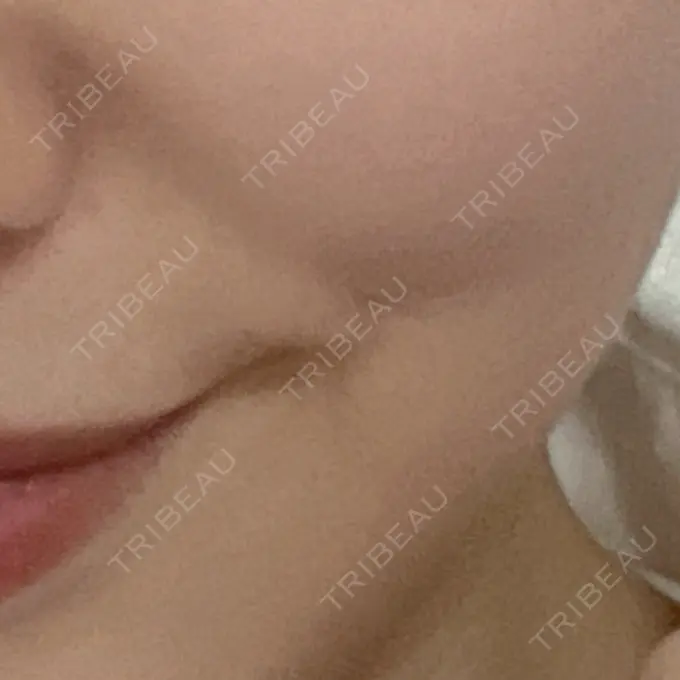 RF（高周波）たるみ治療 表参道メディカルクリニック 表参道院 AFTER メイン用