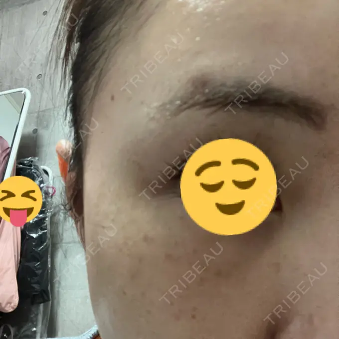 ボトックス（目尻） 東京美容医療クリニック 池袋院 DAY 1 メイン用