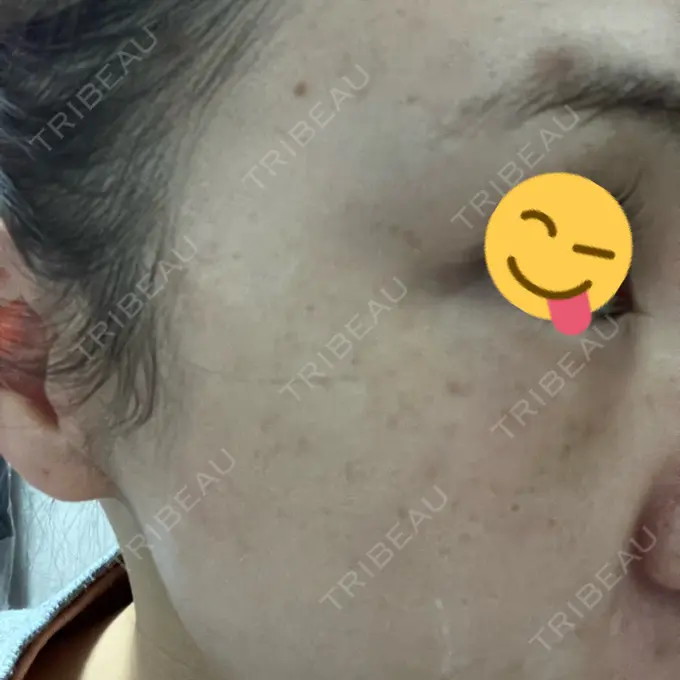 ボトックス（目尻） 東京美容医療クリニック 池袋院 DAY 1 メイン用