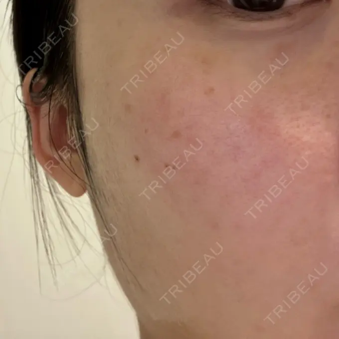 スネコス ルラ美容クリニック 仙台院 / ルラスキンクリニック 仙台院 DAY 8 メイン用