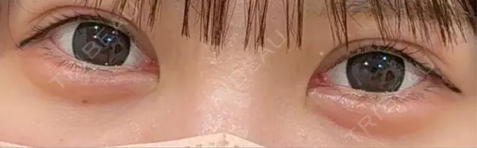 二重埋没 / 上まぶたの脂肪取り / ヒアルロン酸注入（涙袋） アリエル美容クリニック 横浜院 AFTER メイン用