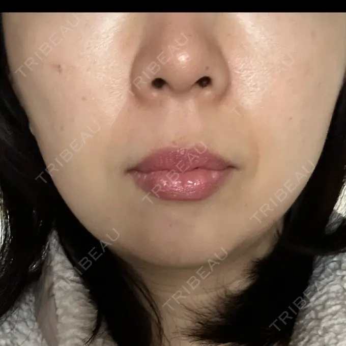 光治療（フォトフェイシャルなど） Sea Sail Beauty Clinic AFTER メイン用