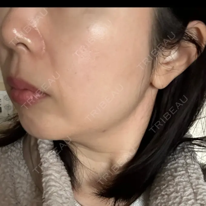 光治療（フォトフェイシャルなど） Sea Sail Beauty Clinic DAY 12 メイン用