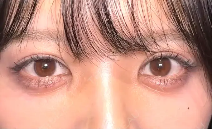 二重切開 / 眼瞼下垂（切開） eクリニック 新宿院 AFTER メイン用
