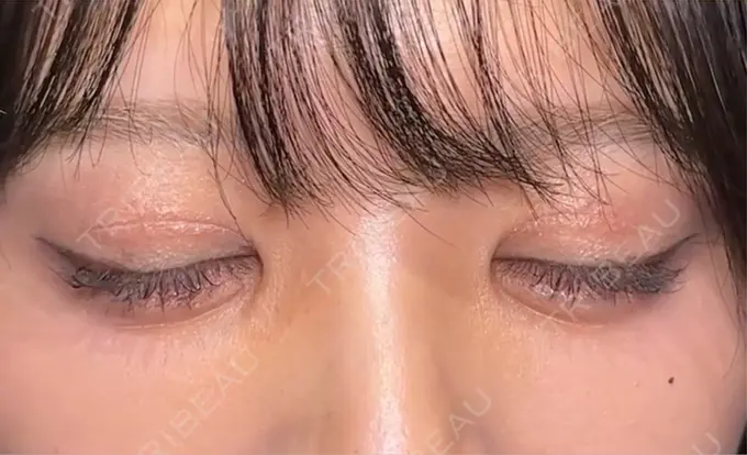 二重切開 / 眼瞼下垂（切開） eクリニック 新宿院 DAY 212 メイン用