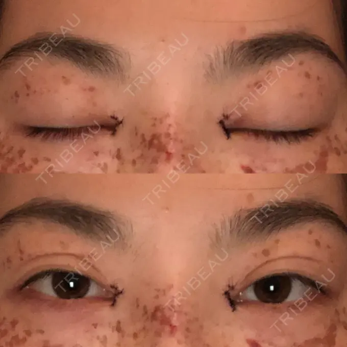 目頭切開 湘南美容クリニック 橋本院 DAY 0 メイン用