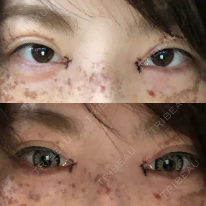 目頭切開 湘南美容クリニック 橋本院 DAY 0 メイン用