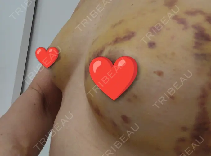 豊胸（脂肪注入） 湘南美容クリニック Regno 銀座院 DAY 7 メイン用