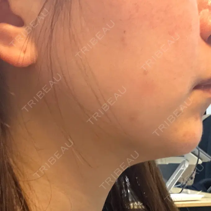 RF（高周波）たるみ治療 ゆきスキンクリニック 東池袋 DAY 7 メイン用