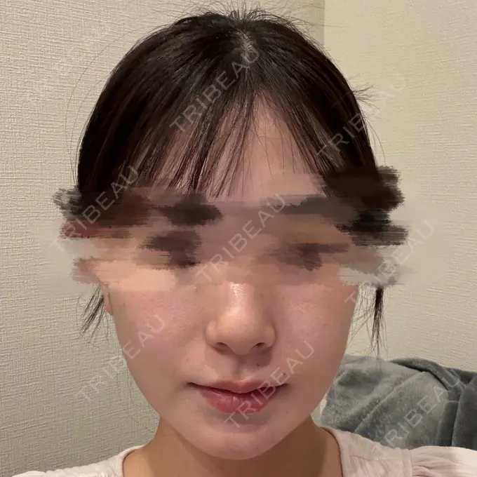 糸リフト / 脂肪吸引（顔） / インディバ（顔） / ヒアルロン酸注入（あご） / ボトックス（エラ・小顔） First Clinic AFTER メイン用