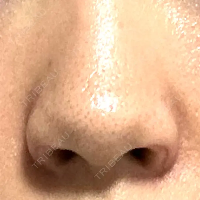 鼻孔縁挙上 シエルクリニック DAY 12 メイン用