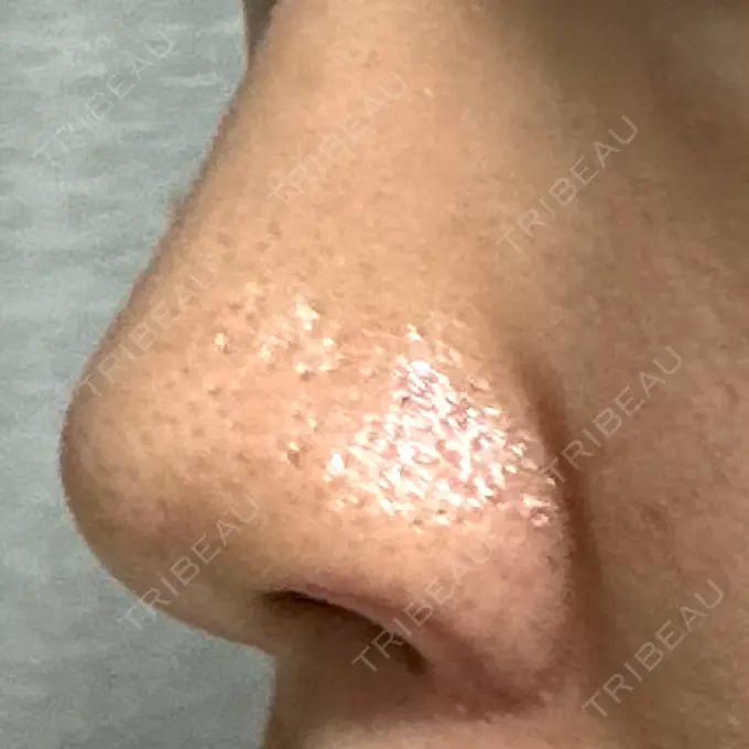 鼻孔縁挙上 シエルクリニック DAY 12 メイン用